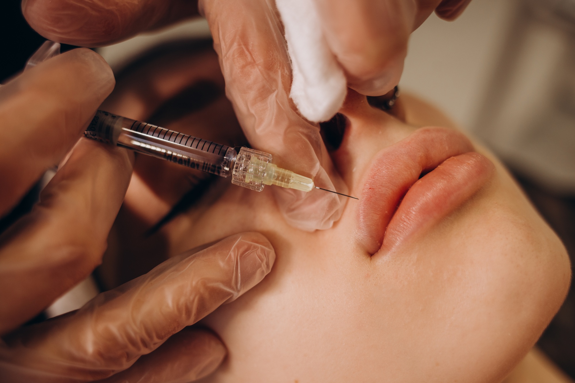 Close up of hands of cosmetologist making botox injection in female lips. She is holding syringe.